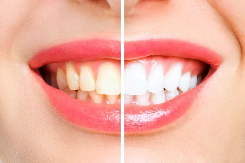 before after dental demo webp (1)
