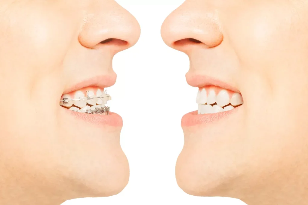 before after dental demo webp (2)